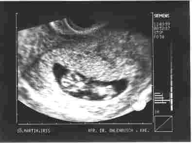 "Gummibrchen"-Ultraschall